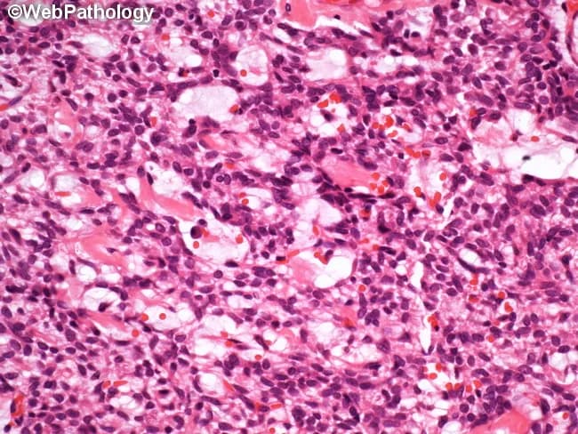 Imaging modality and technique: Bright-field light microscopy of formalin-fixed, paraffin-embedded salivary gland tissue stained with Hematoxylin and Eosin. The specimen represents a pleomorphic adenoma, a benign mixed tumor classically containing epithelial ductal elements and myoepithelial cells within a variably myxoid to chondromyxoid hyalinized stroma. In this high-power field, spindle- to stellate-shaped myoepithelial cells form a loose reticular network around ducts and tubules. The epithelial component yields small duct-like structures and occasional acinar- or tubuloductal formations; the neighboring stroma is abundant, eosinophilic, and matrix-rich, often displaying cartilaginous or myxoid differentiation. Cellular morphology shows spindle-shaped myoepithelial cells with scant cytoplasm and elongated nuclei, embedded in a matrix that may resemble cartilage or fibrous stroma. The lesion is typically well-circumscribed with minimal cytologic atypia and rare mitotic figures. Diagnostic significance resides in recognizing this classic constellation, supporting a benign diagnosis and guiding management toward definitive surgical excision. Clinically, pleomorphic adenoma typically presents as a slow-growing, painless parotid mass; differential diagnoses include adenoid cystic carcinoma and mucoepidermoid carcinoma; radiology and FNA assist preoperative planning. This image also supports AI-based pattern recognition in histopathology, illustrating tumor-stroma interactions and the reticular myoepithelial network associated with chondromyxoid differentiation.