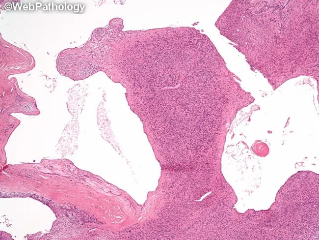 This histopathology image depicts a pleomorphic adenoma of a salivary gland showing prominent cystic change. Prepared as a hematoxylin and eosin stained paraffin section, the sample is examined under light microscopy at low to moderate magnification. The lesion demonstrates the classic biphasic composition of pleomorphic adenoma: ductal epithelial and myoepithelial cells forming primitive acini, embedded in a variable stromal background that ranges from myxoid to chondroid (cartilaginous) stroma. In this instance, extensive cystic degeneration creates large cystic spaces dissecting through glistening, acellular or loosely cellular stromal areas. The cyst lining may be attenuated epithelium or flattened cells with turbulence of mucinous content in the luminal space. The epithelial components show bland cytology without significant pleomorphism or atypia; mitotic activity is low. The myoepithelial cells contribute spindle to plasmacytoid differentiation, contributing to the chondromyxoid stroma. These cystic changes can be primary, or secondary to prior fine-needle aspiration or manipulation, which has diagnostic implications to avoid misinterpretation as a cystic carcinoma or necrotic process. Clinically, pleomorphic adenoma presents as a slow-growing, painless parotid or minor salivary gland mass. Recognition of cystic change is essential to accurate diagnosis, appropriate surgical planning, and margin assessment to minimize recurrence.