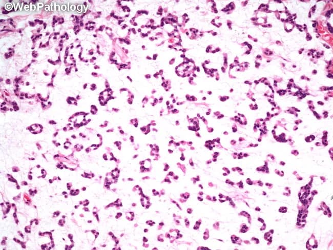 Imaging modality and technique: Light microscopy of a hematoxylin and eosin (H&E) stained salivary gland tissue section analyzed at high magnification, illustrating pleomorphic adenoma features. Anatomic location: parotid or salivary gland region; primary subject and tissue: salivary gland epithelium with myoepithelial components embedded in a myxoid/chondromyxoid stroma. Visual features: epithelial nests and tubules with cuboidal to columnar lining, intermingled with plasmacytoid or spindle-shaped myoepithelial cells; the background matrix is myxoid, frequently with mucopolysaccharide-rich stroma and occasional cartilaginous differentiation. The lesion is typically well circumscribed and shows a biphasic pattern comprising duct-forming epithelial elements and myoepithelial/myxoid components, without conspicuous cytologic atypia or invasion in benign cases. Pathological significance: this classic histology supports a diagnosis of pleomorphic (mixed) adenoma of the salivary gland, a benign tumor with rare malignant transformation and potential for recurrence if incompletely excised. Differential diagnosis: adenoid cystic carcinoma, mucoepidermoid carcinoma, basal cell adenoma, canalicular adenoma; clinical correlation: common presentation as a slow-growing painless parotid or minor salivary gland mass in middle adulthood; relevance to surgical planning and prognosis. Use cases: educational resource, tumor biology study, differential diagnosis training, and pathology exam prep. The image highlights the characteristic biphasic architecture and the myxoid stromal milieu essential for recognizing this entity.