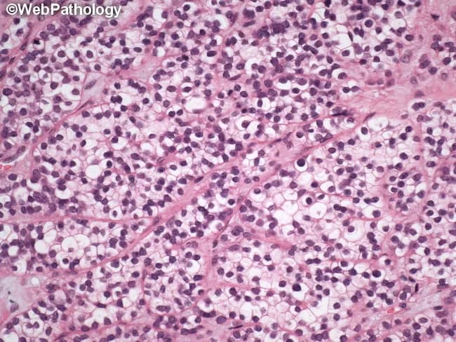 Imaging modality: Light microscopy of a hematoxylin and eosin (H&E) stained salivary gland tissue section, likely parotid, showing microscopic pleomorphic adenoma architecture with epithelial and myoepithelial components embedded in a chondromyxoid stroma. This image highlights a focal clear cell change within the epithelial component: cells with abundant pale, optically clear cytoplasm and centrally placed to slightly eccentric nuclei; the cytoplasmic clearing may reflect glycogen or intracellular mucin. In the background, typical pleomorphic adenoma features include haphazard clusters and nests of duct-like epithelial cells, plasmacytoid myoepithelial cells, and a myxoid to chondroid stroma; stromal regions may appear pink with mucopolysaccharide-rich matrix. The lesion is usually well circumscribed, encapsulated, and shows no invasion into surrounding salivary parenchyma; mitotic activity is low. This histologic variant can mimic other clear cell neoplasms; differential diagnoses include clear cell variant of adenoid cystic carcinoma, mucoepidermoid carcinoma with clear cells, and metastatic clear cell carcinomas; however, the lack of cytologic atypia and invasion supports a benign pleomorphic adenoma with clear cell change. Clinically relevant because recognizing this variant prevents misdiagnosis and guides surgical planning, prognosis, and follow-up in salivary gland tumors. Correlation with imaging and intraoperative frozen section may further aid management.