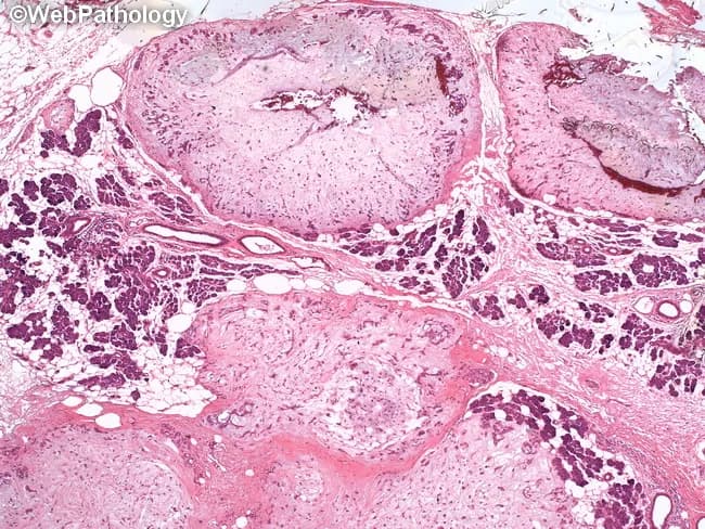 Histopathology of a recurrent multinodular pleomorphic adenoma of salivary gland demonstrates a biphasic tumor with epithelial ductal structures embedded in a variably myxoid to chondroid stroma. The architectural pattern shown is multinodular, with several discrete nodules of tumor separated by thin fibrous septa and by intervening normal salivary gland parenchyma. The stroma is predominantly myxochondroid, ranging from loose myxoid to cartilaginous-like areas, often containing chondroid droplets and cartilaginous differentiation. Ductal and myoepithelial cell populations form spindle to plasmacytoid shapes, with occasional plasmacytoid cells lining ducts. There is no overt cytologic atypia or increased mitotic activity, and perineural and vascular invasion are not evident in this field, consistent with benign histology. The presence of satellite nodules and interposed normal tissue explains the recurrent multinodular growth pattern despite benign behavior. Clinically, this histology supports a diagnosis of pleomorphic adenoma with recurrence, highlighting the importance of complete excision with wide margins to reduce residual disease. The differential diagnosis includes canalicular adenoma, basal cell adenoma, mucoepidermoid carcinoma (in areas of concern for malignant transformation), and adenoid cystic carcinoma (consider if perineural invasion emerges in other sections). Overall, findings correlate with a benign salivary gland tumor showing characteristic myxochondroid stroma.