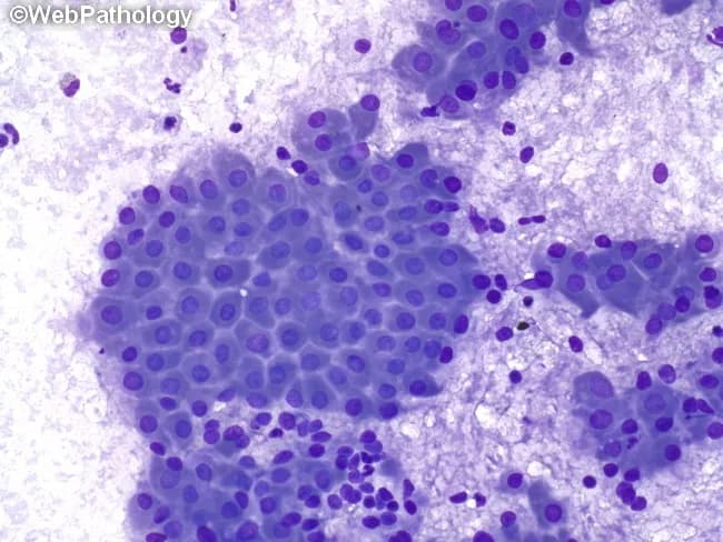 Fine-needle aspiration cytology (FNAC) of a parotid gland lesion demonstrates cohesive sheets and clusters of oncocytic epithelial cells embedded in a lymphoid-rich background. Diff-Quik stained smears reveal cells with abundant granular eosinophilic cytoplasm, round to oval nuclei with smooth nuclear chromatin, and scant cytoplasm at the periphery; occasional mitoses are absent or rare. The inflammatory background consists of mature lymphocytes, plasma cells, and occasional mucus-containing fluid, consistent with Warthin’s tumor (papillary cystadenoma lymphomatosum). The architectural pattern shows double-layered oncocytic epithelium with rosette-like clusters and microcystic spaces; however, cytology often lacks intact glandular ducts, making full histology difficult. Clinically, these findings strongly support a benign parotid tumor; the differential includes pleomorphic adenoma and mucoepidermoid carcinoma, particularly if mucous-producing cells or cytologic atypia are present. The diagnostic significance is high when cytology presents characteristic oncocytic cells and a lymphoid stroma; correlation with imaging and clinical features is essential. Management implications include surgical planning for superficial parotidectomy with facial nerve preservation. In cases with cystic change or hemorrhagic background, FNAC may yield background mucus or thick fluid; the presence of numerous oncocytic cells with dense lymphoid stroma is highly suggestive of Warthin’s tumor. Typical demographic associations include older male patients and parotid localization.