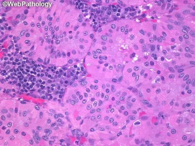 High-magnification light microscopic examination of a salivary gland lesion demonstrates classic Warthin’s tumor (papillary cystadenoma lymphomatosum). The specimen is parotid gland tissue rendered with Hematoxylin and Eosin staining and examined at 400x total magnification (40x objective). The neoplasm shows cystic and papillary architecture lined by a double layer of oncocytic epithelial cells with abundant eosinophilic granular cytoplasm and round, vesicular nuclei bearing prominent nucleoli. Papillary projections project into cystic spaces and are intimately associated with a dense, mature lymphoid stroma; germinal centers may be present within the stroma. The epithelial cells display minimal cytologic atypia and little mitotic activity, consistent with benign behavior. The background lymphoid milieu contains scattered plasma cells, contributing to the characteristic biphasic appearance of Warthin tumor. Overall, the lesion is well circumscribed and lacks invasion of surrounding parotid parenchyma. Clinically, this histology supports a benign salivary gland neoplasm with excellent prognosis following conservative surgical excision (parotidectomy or targeted tumor removal). Differential considerations include pleomorphic adenoma and mucoepidermoid carcinoma, but the combination of oncocytic lining and prominent lymphoid stroma with germinal centers strongly favors Warthin’s tumor. This image is valuable for educational teaching and diagnostic correlation in head and neck pathology. Ideal for radiology-pathology correlation and exams.