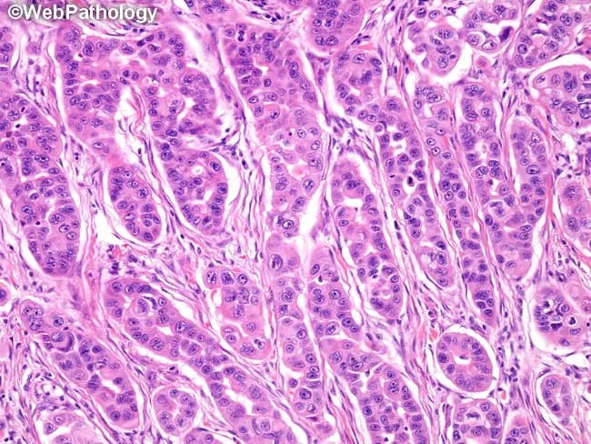 Histopathology image of a recurrent high-grade mucoepidermoid carcinoma arising in the submandibular gland. Specimen: salivary gland tumor, surgical resection. Modality: light microscopy; staining with Hematoxylin and Eosin (H&E), supplemented by mucicarmine highlighting mucous cells. The tumor shows solid architecture with sheets and clusters of epidermoid (squamoid) and intermediate cells, cytologic atypia, prominent nucleoli, and brisk mitotic activity. There is little to no cyst formation or conspicuous keratinization; keratin pearls are sparse or absent; intercellular bridges may be evident in epidermoid components. Scattered mucous-producing cells are mucicarmine-positive, supporting a diagnosis of mucoepidermoid carcinoma rather than pure squamous cell carcinoma. The lesion is high-grade by criteria: solid growth pattern, marked pleomorphism, high mitotic rate, and infiltrative borders within the submandibular region. Perineural or vascular invasion is not clearly demonstrated in this image. Differential considerations include moderately differentiated squamous cell carcinoma and adenosquamous carcinoma; however, mucous cells and mucin positivity favor MEC with salivary origin. Clinically relevant implications include aggressive behavior, potential for recurrence, and need for complete surgical excision with clear margins; adjuvant radiotherapy may be indicated. This image supports diagnostic histology, grading, and educational staging discussions for head and neck salivary gland neoplasms. Correlation with imaging helps assess regional spread and nodal involvement for staging.