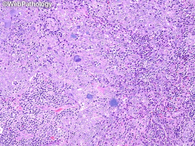 Comprehensive description: Light microscopy of a salivary gland lesion stained with Hematoxylin and Eosin (H&E). The specimen demonstrates a malignant salivary gland neoplasm, most consistent with acinic cell carcinoma. Tumor cells are arranged in sheets and minor acinar differentiation is evident, with a minority of cells showing conventional non-specific glandular morphology. The acinar cells have basophilic cytoplasm rich in coarse granules; cytoplasmic borders are crisp, and nuclei are relatively uniform with mild atypia. The tumor is embedded in a fibrous stroma with mild desmoplasia. An accompanying mild to moderate lymphoplasmacytic infiltrate surrounds tumor nests, and scattered plasma cells are present in the peritumoral milieu. No obvious necrosis is seen. Ductal differentiation is limited, supporting acinic lineage. Mitotic activity is low. Overall, the architecture shows lobulocentric arrangement with cohesive nests of mucin-poor, basophilic cells, consistent with acinic cell differentiation rather than serous acinar cells of normal gland. Clinically, this histology has diagnostic significance for salivary gland neoplasms and helps distinguish from mucoepidermoid carcinoma and adenoid cystic carcinoma; immunohistochemical staining for amylase, DOG1, or S-100 may aid confirmation. This image is suitable for educational pathology, differential diagnosis training, and correlates with radiographic parotid-region masses undergoing parotidectomy. Correlative molecular data may refine classification.