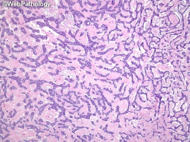Imaging modality: Light microscopy of a hematoxylin and eosin stained histology slide from salivary gland tissue. The lesion demonstrates adenoid cystic carcinoma with classic cribriform architecture and multiple pseudocystic spaces. These gland-like spaces are variably sized and filled by dense, eosinophilic hyaline material representing duplicated basement membrane (basement lamina) produced by tumor cells. The basaloid neoplastic cells are arranged in small nests and narrow cords, with scant cytoplasm, oval to elongated (sometimes hyperchromatic) nuclei, and mild to moderate cytologic atypia. Delicate lace-like bands of stroma separate nests, creating a sieve-like, Swiss-cheese appearance. Overall tumor pattern may show admixtures of tubular and solid growth, but the cribriform component is prominent. The hyaline material within pseudocysts and the presence of basaloid cells support a diagnosis of adenoid cystic carcinoma. Clinically, ACC is associated with infiltrative growth and perineural invasion, contributing to local recurrence despite modest mitotic activity. This image is particularly relevant for educational purposes in surgical pathology, histology curricula, and diagnostic radiology correlations, aiding differentiation from polymorphous adenocarcinoma, mucoepidermoid carcinoma, and other salivary gland neoplasms. It provides a reference for recognizing the hallmark features in biopsy specimens and practicing pattern-based diagnosis.