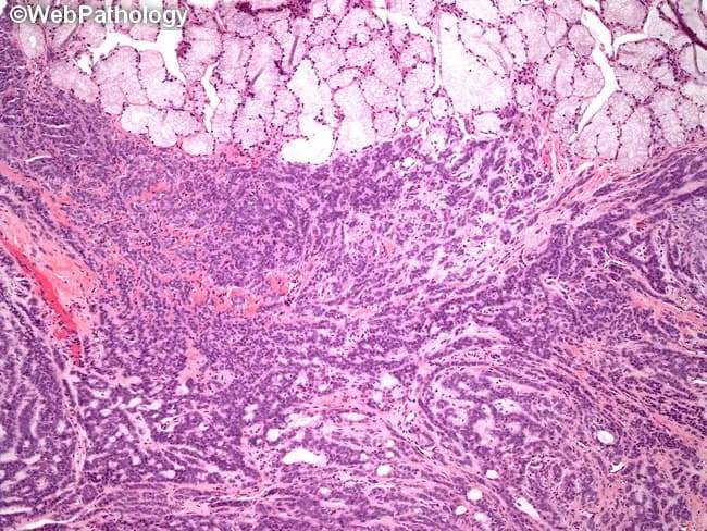 Low-power histology image of salivary gland tissue demonstrates polymorphic architectural patterns characteristic of polymorphous low-grade adenocarcinoma (PLGA). The section, stained with Hematoxylin and Eosin and viewed under light microscopy, shows residual benign minor salivary gland acini at the superior margin, providing an architectural reference for the tissue of origin. Tumor appears infiltrative within fibrous stroma, displaying a spectrum of growth patterns including tubular (glandular), cribriform, solid, papillary, trabecular, and single-file arrangements. The epithelial cells are relatively uniform, with small to moderate nuclei, inconspicuous nucleoli, and minimal cytologic atypia, consistent with a low-grade malignancy. Some areas exhibit a loosely arranged, hammock-like cellular nests that contribute to the polymorphous appearance. The overall patterning, combined with the intimate admixture of benign acini, supports a salivary gland neoplasm rather than a purely benign lesion. Diagnostic significance lies in recognizing architectural diversity as a hallmark of PLGA, which needs correlation with growth pattern and clinical behavior. Differential diagnoses include adenoid cystic carcinoma (cribriform pattern and perineural invasion), mucoepidermoid carcinoma, basal cell adenoma or carcinoma, and benign pleomorphic adenoma in the appropriate clinical context. This image is educational for pathology residents and clinicians learning salivary gland tumor histology and differential diagnosis.