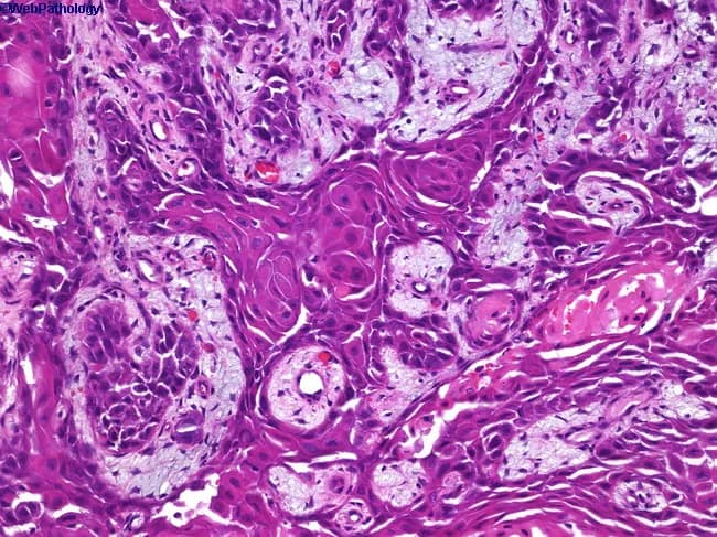 High-quality hematoxylin and eosin stained histology slide of cutaneous tissue shows invasive squamous cell carcinoma. The epidermis exhibits atypical squamous cells with pleomorphic, hyperchromatic nuclei and abundant eosinophilic cytoplasm. In several foci, nests and cords of neoplastic squamous cells invade the underlying dermis, producing a desmoplastic stromal response. Keratinization is evident, with formation of squamous keratin pearls and foci of intracellular keratinization within aggregates of tumor cells. Intercellular bridges are conspicuous at higher magnification. Mitoses are present, including atypical figures, supporting malignant proliferation. The surrounding stroma contains chronic inflammatory infiltrate. Some areas reveal perineural or lymphovascular invasion are suspected but not definitively demonstrable at this magnification. The lesion most consistent with cutaneous squamous cell carcinoma (epidermoid carcinoma) in sun-damaged skin; differential considerations include keratoacanthoma, desmoplastic melanoma, or basal cell carcinoma with squamous differentiation, but the conspicuous keratin production and invasive cords favor SCC. Clinically, this entity is associated with sun exposure, metastasis risk to regional lymph nodes, and requires surgical excision with adequate margins; prognosis depends on depth of invasion and perineural involvement. This image is relevant for dermatopathology, surgical oncology, and educational training in histologic grading of skin cancers.