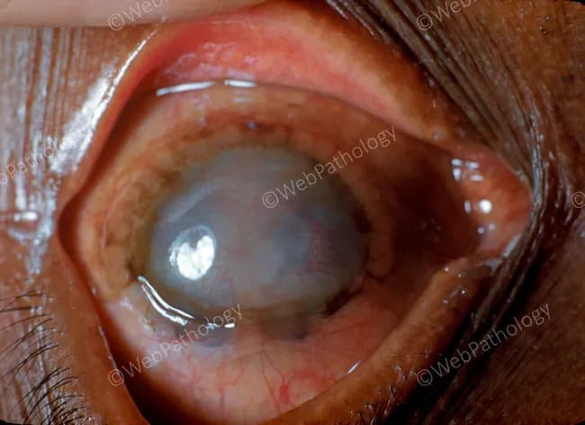 Clinical slit-lamp photograph of the anterior segment and surrounding ocular adnexa, captured in vivo with slit-lamp illumination. The image depicts sympathetic ophthalmia: a painful, inflamed eye following prior penetrating trauma to the contralateral eye, now showing diffuse granulomatous uveitis with anterior chamber reaction and corneal edema. The anterior segment appears hazy with reduced red reflex, posterior synechiae may be present; keratic precipitates typical of granulomatous uveitis may be suspected. The iris may show mutton-fat keratic precipitates and choroidal involvement is suggested by dull, grayish subretinal elevation; subtle exudative retinal changes can accompany inflammation. The image emphasizes bilateral immune-mediated inflammation of the uvea (iris, ciliary body, choroid) with potential involvement of the choroid and retina, consistent with sympathetic ophthalmia. Clinically significant, this condition is vision-threatening if not promptly treated, with autoimmune bilateral granulomatous panuveitis. Diagnostic significance includes correlation with a recent ocular injury and sympathetic response in the fellow eye, and histopathology would reveal granulomatous infiltration with epithelioid cells. Potential clinical uses include education, differential diagnosis training for granulomatous uveitis, and tele-ophthalmology triage. Therapeutic relevance lies in early systemic steroids and immunomodulatory therapy to suppress the autoimmune attack and preserve vision; urgent ophthalmologic consultation is essential for optimal management and research.