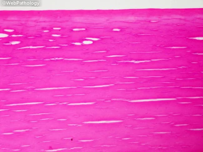 Light microscopy of an H&E-stained crystalline lens section depicting nuclear sclerosis in cataract. The image focuses on the lens nucleus, with a longitudinal sectional plane through the central optical portion. The nucleus shows markedly increased eosinophilia, reflecting dense, protein-rich crystallin accumulation, and overall homogenization of the normally granular lamellar architecture. Normal, alternating lens fiber lamellae are partially obscured by progressive crowding and coalescence of advanced nuclear cataract material. The tissue appears more compact and optically dense, with reduced delimitation between fibers and diminished cytoplasmic clear spaces. The staining accentuates the eosinophilic, pale pink matrix consistent with protein aggregation and cross-linking typical of senile nuclear cataract. Clinically, this pattern corresponds to opacity of the central visual axis, decreased light transmission, and a tendency toward a myopic shift. The histologic features align with chronic degenerative changes in aging lens, including protein denaturation, crystallin aggregation, and lens hardening (sclerosis). Diagnostic significance: confirms nuclear sclerosis type cataract pathogenesis; aids educational correlation between microscopic appearance and opacification. Potential clinical uses: histopathology teaching slide, correlation with slit-lamp findings, research into age-related lens protein chemistry, and evaluation of cataract progression in experimental models. Also note the absence of inflammatory infiltrates.