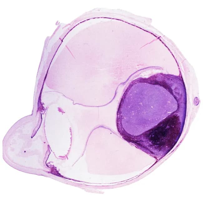 Brightfield light microscopy of a hematoxylin and eosin stained sagittal cross‑section through an ocular globe. The slide displays the layered architecture of the eye, with a prominent circular structure representing the crystalline lens encased by a thin capsule and adjacent zonular fibers. Surrounding tissues reveal the scleral white of the globe and the immediately subjacent uveal tissues, including choroid and pigmented retinal pigment epithelium, transitioning to the multi‑layered neural retina at the inner surface. Nuclei appear dark purple on hematoxylin, while cytoplasm and extracellular matrix stain pink to pale pink, creating distinct optic nerve/retinal nerve fiber layer boundaries peripherally and centrally. The vitreous body appears relatively acellular and eosinophilic, separating the lens from the retina. The optic axis and ciliary body regions may be suggested at the periphery by tubular structures and vascular patterns. Overall, this image demonstrates normal ocular histomorphology suitable for educational reference, anatomical atlas documentation, and pattern recognition training in ophthalmic pathology. Potential clinical applications include teaching ocular anatomy (globe, lens, retina, sclera, choroid), diagnosing cataract or retinal disorders in histological specimens, and serving as a baseline for comparative studies in ocular development and disease. This representation emphasizes laminar organization, including anterior corneal–limbal regions not visible here, posterior retina layers such as ganglion cell layer and inner nuclear layer, and lens substructures—capsule, cortex, and nucleus—facilitating recognition tasks for students and clinicians. High-quality reference for ophthalmology education.