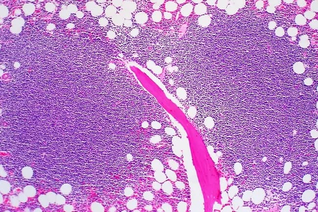 Bone marrow histology from a suspected CLL case illustrating marrow involvement by small mature lymphocytes. Modality: light microscopy; specimen type bone marrow core biopsy with aspirate smear; technique hematoxylin and eosin staining. Infiltration patterns are shown: focal, non-paratrabecular nodules; interstitial admixture of lymphocytes with normal hematopoietic elements; and a rare diffuse, solid pattern appearing dark on low magnification. Lymphocytes comprise more than 30% of marrow cellularity in aspirates, and their morphology mirrors circulating leukemic cells with scant cytoplasm and clumped chromatin. Proliferation foci and true germinal centers are extremely rare. Immunophenotypic profile typically shows clonal B cells expressing CD5 and CD23, with potential ZAP-70 association when diffuse infiltration or high disease burden is present. The presence of extensive solid infiltration correlates with cytopenias, higher clinical stage, and adverse prognosis. The described patterns reflect disease burden and marrow hematopoiesis compromise, with possible implications for therapy and monitoring. Differential considerations include other small B‑cell lymphomas such as mantle cell lymphoma, as well as reactive lymphoid aggregates. Clinical correlation is essential, as marrow involvement informs staging and helps evaluate response to therapy. This image underscores marrow histology’s role in CLL assessment and prognostication. These features aid pathologists, hematologists, and trainees in diagnosis and grading.