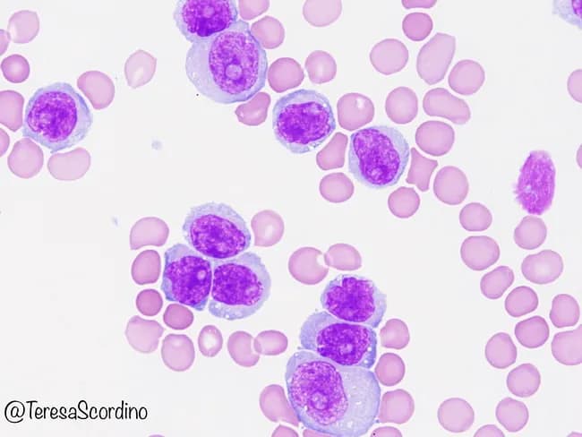 Imaging modality: Bright-field microscopy of Wright-Giemsa stained peripheral blood smear. Anatomical target: circulating peripheral blood cells, with a focus on B-cell prolymphocytes. Visual features: a monomorphic population of medium-to-large lymphoid cells exhibiting round to slightly irregular nuclei, coarse chromatin, and prominent nucleoli; cytoplasm is basophilic and variably abundant; occasional cytoplasmic projections may be seen; the smear background shows scattered erythrocytes and platelets. Overall, leukocytosis with prolymphocytic predominance suggests a malignant B-cell process. Pathological context: morphological hallmarks of B-cell prolymphocytic leukemia (B-PLL), defined by prolymphocytes comprising more than 55% of circulating lymphoid cells in peripheral blood; cells may be part of a systemic leukemia involving bone marrow and spleen. Immunophenotype typically expresses B-cell markers (CD19, CD20) with light chain restriction; immunohistochemistry and flow cytometry are used for confirmation; distinction from mantle cell lymphoma (cyclin D1/MCL) and CLL with increased prolymphocytes is critical. Diagnostic significance: detection of prolymphocytic leukocytes guides prognosis and therapeutic planning, as B-PLL has an aggressive course and limited responsiveness to standard CLL regimens. Clinical correlation: patients are commonly elderly with fatigue, cytopenias, and organomegaly; accurate classification influences treatment choice and clinical trial eligibility; this image serves as an educational reference for hematology, pathology, and medical education.
