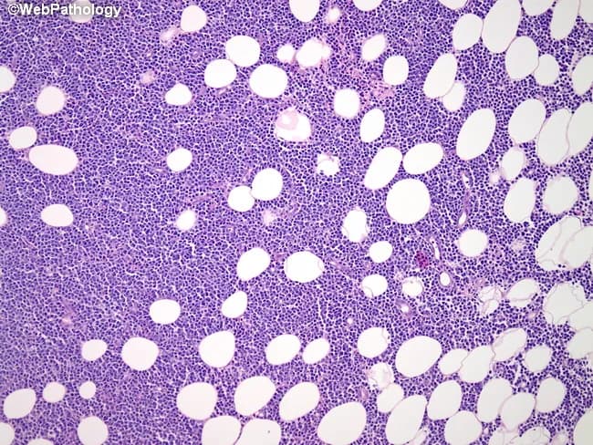 Bone marrow histology on this hematoxylin and eosin–stained section shows diffuse infiltration by mature B-lymphoid cells with prolymphocytic features, partially replacing normal adipocytic marrow. Infiltrating cells are medium to large with round to irregular nuclei, coarse chromatin, conspicuous nucleoli, and scant to moderate cytoplasm. Scattered prolymphocytes are present and background fat cells persist in residual islands; the overall architecture is variably effaced. This pattern is characteristic of bone marrow involvement by B-cell prolymphocytic leukemia (B-PLL). Although immunophenotype cannot be determined on this slide, typical profiles include bright surface immunoglobulin expression with CD19 and CD20 positivity, coexpression of CD5 and FMC7, and often absence of CD23. Clinically, B-PLL affects the elderly and presents with leukocytosis (often >100,000/μL), anemia, thrombocytopenia, and splenomegaly; B symptoms may be present. Relapsed disease can show central nervous system involvement, refractory hypercalcemia, or extramedullary masses. The histopathologic finding confirms marrow involvement and aids staging and management, while recognizing differential diagnoses such as chronic lymphocytic leukemia/small lymphocytic lymphoma, mantle cell lymphoma, hairy cell leukemia, and acute lymphoblastic leukemia. Integrate complete blood count, flow cytometry immunophenotyping, cytogenetics, and molecular studies for definitive classification and prognosis. This image depicts a bone marrow biopsy/aspirate specimen illustrating B-PLL–related marrow infiltration.