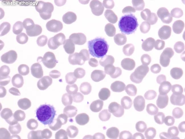 Imaging modality and technique: Light microscopy on peripheral blood smear stained with Wright-Giemsa. Specimen type: peripheral blood smear. Primary subject: Hairy cells. Anatomical context: hematopoietic peripheral blood. Observed morphology: Hairy cells are larger than small lymphocytes, about 1.5–2× the size; nuclei are oval to bean-shaped with open, coarse chromatin and inconspicuous nucleoli. Cytoplasm is moderate in volume, pale blue, with fine, hair-like cytoplasmic projections that extend from the cell surface. Chromatin is evenly dispersed; nucleoli are not prominent. The smear shows scattered hairy cells among a background of normocytic erythrocytes and neutrophils. In some cases cytoplasm may appear flocculent; proplate-like projections are best seen in well-prepared thin areas of smear. This morphology is best appreciated on peripheral smear preparations rather than aspirate smears, where hair projections may be less evident. Diagnostic significance: characteristic hairy cell features suggest a diagnosis of hairy cell leukemia (HCL) in appropriate clinical context; TRAP positivity, CD11c, CD25, and CD103 expression support the diagnosis. Clinical correlation includes cytopenias, splenomegaly, and exposure to risk factors; differential includes other lymphoid and myeloid disorders with cytoplasmic projections or atypical lymphocytes. Utility in education and differential diagnosis: hematology teaching, smear interpretation, cellular morphologic recognition, and confirmation with flow cytometry.