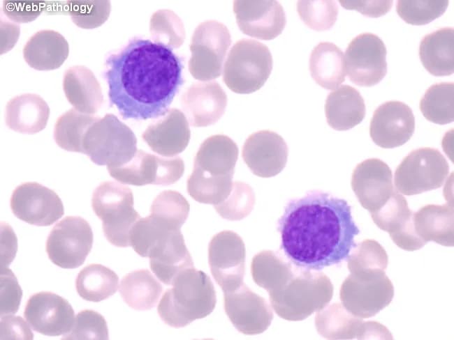 This is a high-magnification brightfield photomicrograph of a peripheral blood smear stained with Wright-Giemsa. The image highlights circulating hairy cells, which are larger than normal lymphocytes (approximately 1.5-2x). Hairy cells exhibit oval to bean-shaped nuclei with finely dispersed chromatin and inconspicuous nucleoli, and a moderate amount of pale, flocculent cytoplasm bearing fine cytoplasmic projections (hairy processes). The cytoplasm appears lightly basophilic and extends as delicate, hairlike extensions into the surrounding specimen. The background contains numerous mature erythrocytes and occasional platelets; there is no prominent nuclear atypia in these cells. Notably, the hairlike cytoplasmic projections are more readily appreciated in well-prepared, thin areas of the smear and are less evident in aspirate smears. This morphology is classically associated with hairy cell leukemia (HCL) and serves as a visual cue prompting confirmatory testing by flow cytometry for CD11c, CD25, CD103, and annexin A1, as well as tartrate-resistant acid phosphatase (TRAP) staining. Clinically, recognizing this pattern supports diagnosis in the appropriate hematologic context and guides subsequent therapeutic decisions. This image is valuable for education in hematopathology, cytology, and differential diagnosis of atypical lymphoid cells. Equivalent images may illustrate variably circulating hairy cells and aid differential diagnosis in practice.