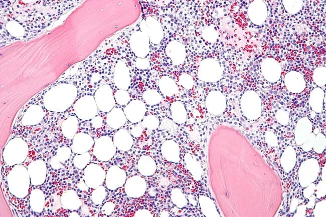 Light microscopy of a bone marrow biopsy from hairy cell leukemia (HCL) shows diffuse infiltration by small to medium lymphoid cells with abundant clear cytoplasm and oval, occasionally reniform nuclei; the cytoplasm creates a fried egg appearance. Hairy projections may be highlighted by immunostaining and by DBA.44 positivity, along with CD11c, CD25, and CD103 markers. The marrow is commonly hypercellular in established disease, whereas early involvement may be hypocellular and mimic aplastic anemia. Prominent reticulin fibrosis is typical and can hinder aspirate yield, making core biopsy essential for assessing infiltration and baseline disease burden. Normal hematopoietic elements, especially the myeloid lineage, are reduced and may display dysplastic changes resembling myelodysplastic syndrome. Plasma cells and mast cells may be mildly increased. In some cases, hairy cells assume a spindle-shaped morphology. The neoplastic cells are typically monotonous with minimal prominent nucleoli, and cytoplasm may exhibit cytoplasmic processes. Unlike several small B-cell lymphomas, discrete cellular aggregates are uncommon, with diffuse replacement predominating. Immunohistochemistry and flow cytometry confirm the diagnosis via characteristic immunophenotype. Clinically, marrow involvement informs staging, prognosis, and treatment planning, though peripheral blood smear and immunophenotypic profiling often suffice for diagnosis. This image, captured at high magnification on a hematoxylin and eosin stained section, showcases classic hairy cell features.