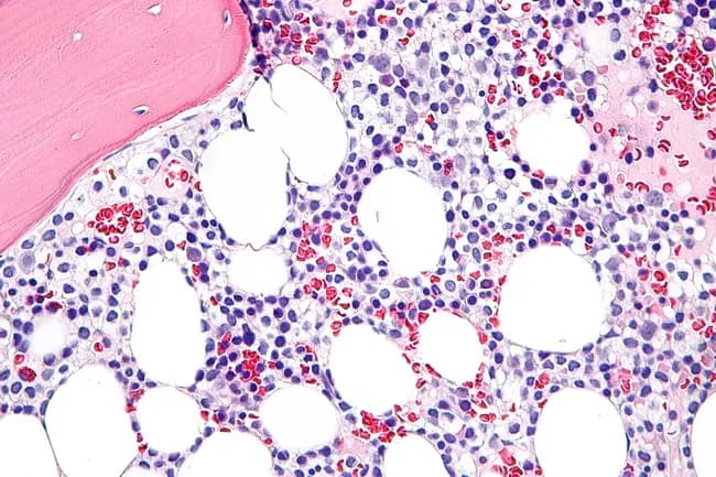 Histopathology: Bone marrow biopsy prepared for light microscopy shows diffuse infiltration by hairy cells rather than well-formed nodules. The marrow is often hypercellular in established disease but can be hypocellular in early stages, mimicking aplastic anemia. Hairy cells appear monotonous with oval nuclei and abundant clear cytoplasm that yields a characteristic fried egg morphology on H&E sections. In some cases, hair-like cytoplasmic projections (hairy indentations) are accentuated with specialized staining such as DBA.44 immunostain, supporting a hairy cell leukemia (HCL) diagnosis. The tumor cells may display spindled forms; the immunophenotype typically includes DBA.44 positivity, and cells may express CD11c, CD25, and CD103 on broader panels. Normal hematopoietic elements, particularly myeloid precursors, are reduced and can show dysplastic changes reminiscent of myelodysplastic syndrome. Plasma cells and mast cells may be mildly increased. Significant reticulin fibrosis is common, contributing to difficult marrow aspirates and making core biopsy essential to determine the extent of marrow replacement. Although marrow evaluation is informative, many cases of HCL can be diagnosed from peripheral blood smear and immunophenotyping alone; however, the biopsy provides baseline disease burden and a reference for assessing therapeutic response and fibrosis progression. This image exemplifies classic HCL marrow involvement with fried egg cells and conspicuous reticulin fibrosis.