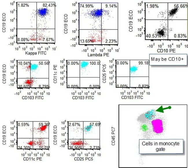 Flow cytometry immunophenotyping of peripheral blood mononuclear cells demonstrating classic hairy cell leukemia phenotype. The panels shown include forward scatter (FSC) and side scatter (SSC) gating with cells occupying the monocyte region outside the lymphocyte gate. The immunophenotype reveals bright CD45 expression with coexpression of B-cell markers including CD19, CD20 (bright), CD22 and CD79a, along with the characteristic hairy cell markers CD11c, CD25, CD103, and CD123. CD79b and CD5 are typically negative; CD10 may be variably expressed in about 10-25% of classic HCL cases as seen here. The combination of CD11c+, CD103+, CD25+, and CD123+ with strong CD19/CD20 and FMC-7 supports a diagnosis of hairy cell leukemia and helps distinguish it from CLL, MCL, and other B-cell neoplasms. The image emphasizes a pattern where neoplastic hairy cells appear outside the lymphocyte gate and within the monocyte gate panels, reflecting the characteristic light-scatter profile (high forward scatter and slightly elevated side scatter). Clinically, this immunophenotype informs treatment planning with purine analogs (cladribine, pentostatin) and supports mutation testing (BRAF V600E) for diagnostic confirmation. This dataset is suitable for education, differential diagnosis teaching, and MRD monitoring by flow cytometry. The image serves as an educational reference for hematology trainees and clinicians in practice.