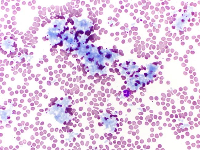 Peripheral blood smear from a patient with Waldenström macroglobulinemia (lymphoplasmacytic lymphoma) showing IgM immunoglobulin aggregates on brightfield microscopy after Wright-Giemsa staining. The smear features numerous small, round erythrocytes with mild central pallor and occasional rouleaux formation, alongside conspicuous blue‑purple proteinaceous aggregates. These aggregates represent high‑molecular‑weight IgM paraprotein that precipitates or polymerizes in serum and circulates as macroglobulins, a hallmark of hyperviscosity syndrome. The IgM‑derived clumps are irregular, amorphous to coarse in appearance, and contrast with the pink cytoplasm of RBCs, producing a striking multicellular landscape. Notably, the leukocyte morphology is not the primary focus here, but scattered neutrophils and mononuclear cells are present. Clinically, the observation supports a diagnosis of Waldenström macroglobulinemia with hyperviscosity-related symptoms, including neuropathy, blurred vision, and headaches. Correlation with serum protein electrophoresis demonstrating an IgM monoclonal spike and elevated serum viscosity is recommended. Therapeutic implications include plasmapheresis to rapidly lower IgM‑driven viscosity, followed by disease‑modifying therapy (e.g., rituximab‑based regimens, proteasome inhibitors). This image is valuable for hematology education, cytology training, and case-based teaching on IgM paraproteinemia. This image also highlights the importance of distinguishing extracellular IgM aggregates from cellular inclusions, and demonstrates how sample handling and temperature can influence aggregate formation.