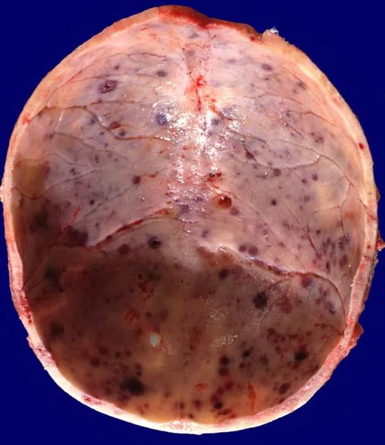Gross pathology photograph of calvarial skull bones from a 60-year-old male with plasma cell myeloma showing multiple round lytic lesions. The skull base and vault are involved with discrete, punched-out defects ranging approximately 1 to 4 cm in diameter. The lesions are filled with soft, gelatinous red-brown tumor tissue, giving the inner table a slightly eroded appearance and thinning of the surrounding cortex. The overlying periosteum is variably preserved; surrounding diploic spaces may appear expanded and vascularized. The appearance is characteristic of osteolytic activity produced by clonal plasma cells that suppress normal bone formation and promote bone resorption, commonly involving the vertebral column, skull, ribs, pelvis, proximal long bones, and clavicles. In this specimen, the cranial vault bears multiple nodular foci with conspicuous dark hematopoietic plugs and subtle hemorrhagic foci. The gross features correlate with radiographic images of lytic skull lesions seen in multiple myeloma, or plasmacytomas, and reflect high tumor burden. Clinically, these findings support a diagnosis of multiple myeloma in the appropriate systemic context (anemia, hypercalcemia, renal dysfunction, monoclonal protein). Differential diagnoses include metastatic cancer and Langerhans cell histiocytosis. This image is useful for surgical pathology education, gross anatomy training, and radiology-pathology correlation exercises.