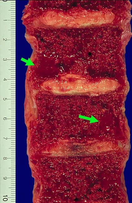 Gross pathology photograph of a spinal vertebral section showing multiple destructive lytic lesions characteristic of plasma cell myeloma involving the axial skeleton. The specimen comprises several contiguous vertebral bodies with preserved posterior elements, oriented in a sagittal plane to expose the cancellous marrow and trabecular bone within. Lesions are red-brown, gelatinous, soft-tissue masses within the vertebral bodies, replacing normal bone marrow and producing conspicuous cortical thinning. The surrounding marrow is dark red and congested, with focal areas of hemorrhagic discoloration. The left side features a centimeter-scale ruler for gross correlation, underscoring the lesion's extent and the degree of vertebral body destruction. Clinically, such lytic vertebral involvement commonly presents with axial bone pain, especially in the back, and may lead to vertebral collapse and potential spinal cord compression. Hypercalcemia from bone resorption can manifest as confusion, weakness, lethargy, constipation, and polyuria. While histology would show sheets of malignant plasma cells with CD138 positivity and light-chain restriction, this gross image emphasizes the destructive bone disease pattern. The image supports radiographic correlation, biopsy planning, and staging assessment in multiple myeloma management. For diagnostic, educational utility, and research applications.