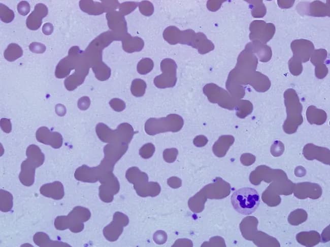Imaging modality: Brightfield light microscopy of a Wright-Giemsa stained peripheral blood smear. The smear demonstrates marked rouleaux formation of red blood cells, with cells stacking in linear, coin-like columns typical of hypergammaglobulinemia. The background appears subtly bluish, reflecting increased serum proteins and altered stain uptake produced by monoclonal immunoglobulin (M-protein) in the plasma. Occasional circulating plasma cells are visible, consistent with plasma cell dyscrasia; in advanced myeloma this may progress to marked plasmacytosis or plasma cell leukemia. Note that rouleaux is not specific for plasma cell disorders and can occur with other states that raise immunoglobulin levels, such as systemic lupus erythematosus, chronic infections, and HIV. The combination of RBC rouleaux and blue background staining on Wright-Giemsa supports a workup for a monoclonal gammopathy; definitive diagnosis requires serum protein electrophoresis, immunofixation, free light chain assay, and bone marrow examination. Clinically, these findings correlate with increased plasma viscosity and potential hyperviscosity symptoms; they also influence automated hematology analyzer results and guide diagnostic sequencing in hematology-oncology. This image is valuable for education on rouleaux pathophysiology, differential diagnoses of gammopathy, and recognition of circulating plasma cells in blood. This image supports educational discussion in hematology and medical diagnostics. Useful for exam review, case conferences, and AI image recognition benchmarks.