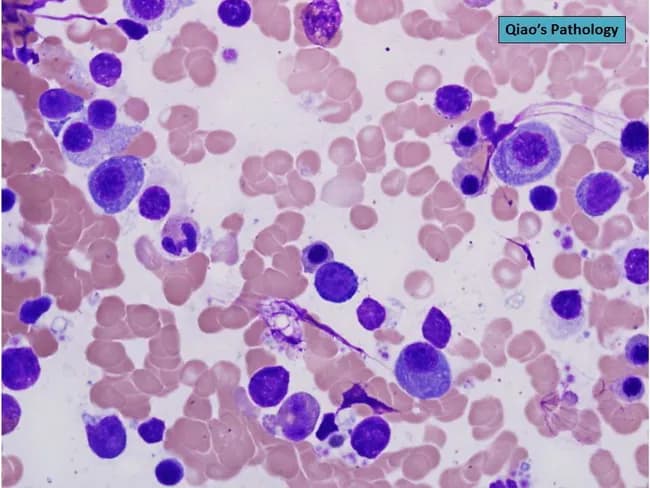 Brightfield light microscopy of a Wright-Giemsa stained bone marrow aspirate smear at 100x oil immersion reveals a quantitative increase in plasma cells with intermediate maturation (between mature and immature) among a heterogeneous hematopoietic background of erythroid and myeloid precursors. The plasma cells are characterized by relatively abundant basophilic cytoplasm containing granular inclusions and by moderately dispersed chromatin in their nuclei. Some cells appear with eccentric nuclei and prominent cytoplasmic features typical of plasma cells, while others show more condensed nuclear chromatin suggesting an intermediate maturation stage. The smear lacks a delicate histologic architecture but demonstrates a clonal-appearing proliferation pattern in aspirate cytology; background hematopoiesis includes mature and immature forms. Overall, these features point toward plasmacytosis and warrant differentiation between reactive plasmacytosis and neoplastic plasma cell disorders. Clinically, increased plasma cells in bone marrow can reflect plasma cell dyscrasias such as multiple myeloma, MGUS, or plasmacytoma, or reactive processes secondary to infection or autoimmune disease. Diagnostic significance hinges on ancillary testing: flow cytometry for clonality, immunoglobulin profiling (serum protein electrophoresis and immunofixation), serum free light chains, and bone marrow cytogenetics. This image is valuable for education, differential diagnosis, and correlating morphological features with clinical investigations in hematology and pathology for diagnostics.