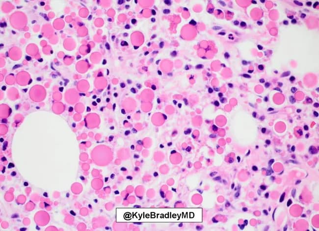 Imaging modality: light microscopy, bright-field, with hematoxylin and eosin staining of a bone marrow core biopsy. Specimen shows a cellular marrow with sheets of plasma cells occupying a large proportion of the tissue, interrupting normal hematopoietic elements. The malignant plasma cells display classic features of plasma cell neoplasia, including eccentric nuclei and coarse clumped chromatin, and abundant cytoplasm. Within many plasma cells, there are eosinophilic cytoplasmic inclusions representing Russell bodies (immunoglobulin condensations). The distribution is diffuse and sheets are interspersed with residual adipocytes and scattered karyorrhectic debris. The background shows mild interstitial fibrosis and occasional binucleated plasma cells. Notable bystander plasma cells are present but in smaller numbers, consistent with clonal proliferation. In the context of myeloma, such marrow involvement supports a diagnosis of multiple myeloma with heavy plasmacytosis and intracellular immunoglobulin accumulation. Clinically, this morphology prompts ancillary testing including serum protein electrophoresis, immunofixation, and light chain assay to determine monoclonality and disease burden. The image is valuable for educational illustration of Russell bodies in myeloma, differential diagnosis of plasmacytosis, and for correlating histology with cytology and radiology in diagnostic workups. It serves as a reference for hematopathology trainees and pathology education in plasma cell dyscrasias.