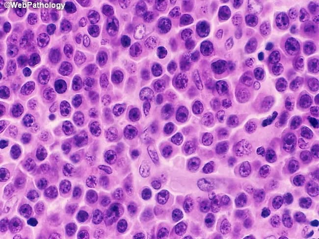 Histology, Light microscopy; bone marrow trephine biopsy stained with Hematoxylin and Eosin (H&E). The specimen shows extensive replacement of normal hematopoietic elements by sheets of immature plasma cells, consistent with marrow involvement by plasma cell myeloma. The infiltrate is markedly cellular with high nuclear-to-cytoplasmic ratio, round to oval nuclei, coarse clumped chromatin, and inconspicuous nucleoli in many cells. Nucleoli are more prominent in a subset of plasma blasts, and some cells display multinucleation. The cytoplasm is variably basophilic and often abundant, contributing to a purple to pink background. The normal marrow architecture is effaced; residual hematopoiesis is sparse. Occasional binucleated or trinucleated plasma cells may be seen; mitotic figures can be present, reflecting active proliferation. The overall pattern is diffuse, with possible focal aggregates. In non-secretory myeloma, as in this case, monoclonal plasma cell proliferation can be demonstrated by immunohistochemistry for kappa or lambda light chains and by molecular studies showing clonal rearrangements, even in the absence of detectable M protein in serum or urine. However, this image itself shows characteristic plasma cell morphology and marrow effacement; clinical correlation with serum free light chains and immunophenotyping is essential for diagnosis and staging. This histopathology supports a diagnosis of multiple myeloma with marrow involvement.