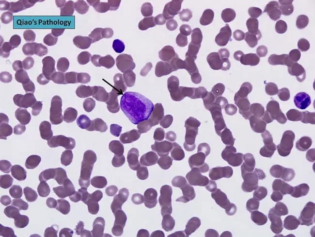 Comprehensive description: Brightfield light microscopy image of a peripheral blood smear stained with Wright-Giemsa, captured at high magnification to visualize circulating plasma cells. The central plasmablast shows an enlarged, irregular nucleus with a prominent nucleolus; the cytoplasm is moderately basophilic. This cell appears larger than surrounding erythrocytes and is consistent with malignant plasma cells typical of plasma cell leukemia. The background demonstrates rouleaux formation of red blood cells, a common feature in paraproteinemias due to increased serum proteins. The smear illustrates plasmacytosis that, when exceeding 20% of leukocytes, supports a diagnosis of plasma cell leukemia. In PCL, neoplastic plasma cells may be CD56 negative and often secrete monoclonal immunoglobulin with IgD or IgE isotypes or light-chain restriction; cytogenetic abnormalities are frequently observed. Morphology alone cannot definitively distinguish PCL from aggressive myeloma; immunophenotyping and cytogenetic studies are essential for precise classification. This image is valuable for hematology education, cytology review, and discussions of malignant plasma cell disorders, including primary versus secondary PCL, and their prognostic significance. Potential clinical utilities include morphologic confirmation in suspected PCL, training in recognition of plasmablasts, and correlation with CBC abnormalities and clinical features such as anemia, thrombocytopenia, lymphadenopathy, and organomegaly.