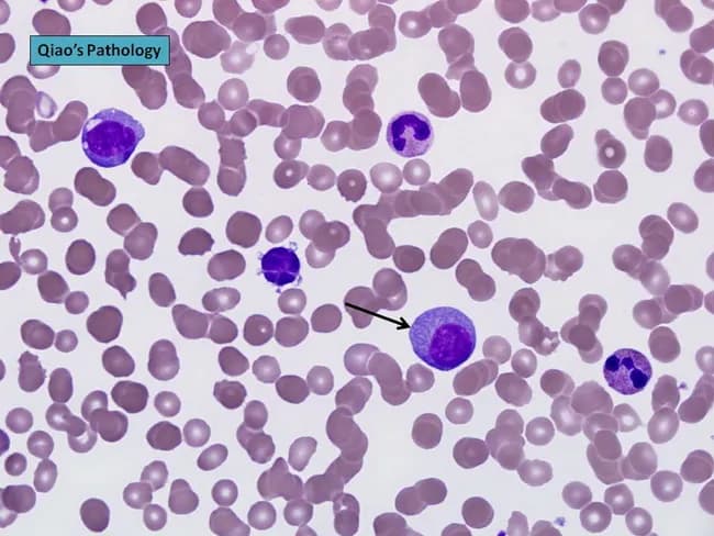 Peripheral blood smear prepared with Wright-Giemsa stain and examined under brightfield illumination using a 100× oil immersion objective reveals a single large plasma cell among a field of mature erythrocytes. The plasma cell displays features typical of clonal plasma cells: basophilic cytoplasm, an eccentrically placed round nucleus, and a conspicuous perinuclear hof; background shows rouleaux formation of red cells. This image exemplifies hematologic involvement by a plasma cell dyscrasia. In plasma cell leukemia, circulating plasma cells constitute more than 20% of leukocytes, a hallmark distinguishing it from conventional multiple myeloma, although both conditions share monoclonal plasma cell proliferation. The presence of circulating plasma cells is associated with younger patient age, higher incidence of anemia, thrombocytopenia, organomegaly, and possible lymphadenopathy; however lytic bone lesions may be less common. Immunophenotypic patterns often include lack of CD56 expression relative to myeloma. Clinically, this morphological finding warrants confirmation with complete blood count, peripheral smear review, quantitative plasma cell percentage, serum protein electrophoresis, and immunofixation to identify monoclonal immunoglobulin isotype (IgD/IgE or light-chain predominance). Early detection of circulating plasma cells supports prognosis assessment and guides therapy decisions in plasma cell dyscrasia management and monitoring, including risk stratification and treatment response evaluation for practice in clinics.