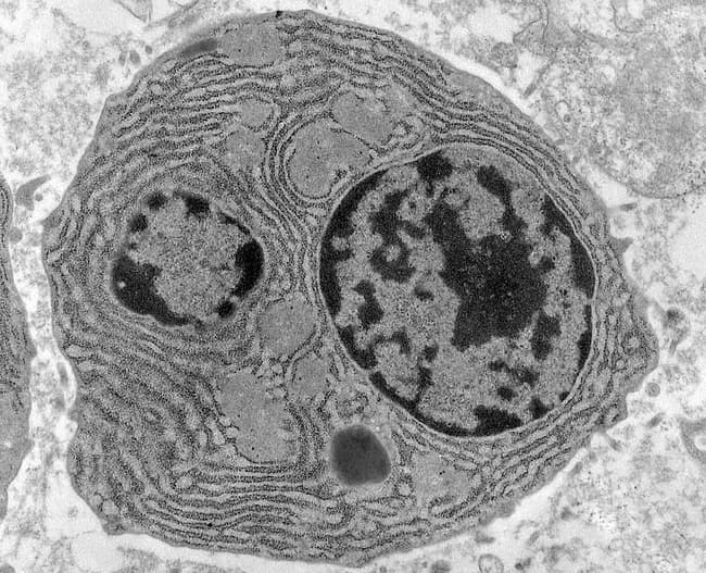 Transmission electron microscopy image of bone marrow plasma cells in multiple myeloma, highlighting ultrastructural features of malignant plasmacytosis. The specimen is a bone marrow biopsy/aspirate subjected to TEM to reveal subcellular architecture at high magnification. The primary subject is a plasma cell characterized by a prominent, eccentrically placed nucleus with chunky, irregular clumped chromatin and abundant cytoplasm. Bi- or multinucleation is frequently observed in myeloma cells. The cytoplasm shows extensive rough endoplasmic reticulum organized in parallel lamellae, reflecting heavy immunoglobulin synthesis. Light gray, round to ovoid cytoplasmic inclusions known as Russell bodies are evident within the cytoplasm, representing condensed immunoglobulin within intact endoplasmic reticulum. The cellular borders are well defined, and there is sometimes distension of the ER cisternae near the perinuclear region. The image underscores hallmark features of malignant plasma cells in multiple myeloma and demonstrates both proliferative activity and high secretory load. Clinically, these ultrastructural findings correlate with a high monoclonal immunoglobulin production and marrow infiltration, informing prognosis and therapeutic decisions when integrated with light-chain studies and routine histology. This EM view complements light microscopy by providing evidence of intracellular organelle expansion and intracellular inclusions that are not discernible with conventional staining. Potential educational use includes teaching plasmacytosis, plasma cell neoplasia morphology, and EM-based diagnostic histopathology.