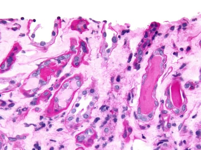 Imaging modality: Brightfield light microscopy of a renal cortical biopsy section stained with Periodic Acid-Schiff (PAS). The section demonstrates tubulointerstitial injury with intratubular casts. In myeloma cast nephropathy, casts formed from monoclonal light chains may be PAS-negative, appearing pale pink (left side of the reference image), in contrast to hyaline casts, which are PAS-positive and stain dark pink (right side). Myelomatous (light-chain) casts obstruct tubule lumens, often with relative sparing of glomeruli in the presented field, and are composed of monoclonal immunoglobulin light chains that precipitate within distal tubules and collecting ducts. The PAS counterstain highlights basement membranes and surrounding stroma, facilitating assessment of cast distribution and tubular injury. Clinically, this pattern supports a diagnosis of cast nephropathy secondary to multiple myeloma or Waldenström-like disorders with excessive free light chains. The differential includes simple hyaline casts and other tubular casts seen in dehydration, nephrotoxicity, or ATN; immunostaining and light-chain restriction studies may be required for confirmation. The diagnostic significance lies in identifying myeloma cast nephropathy, which guides oncologic therapy and renal prognosis. Potential clinical uses include assessment of renal involvement in plasma cell dyscrasias, monitoring treatment response, and prognostication in multiple myeloma.