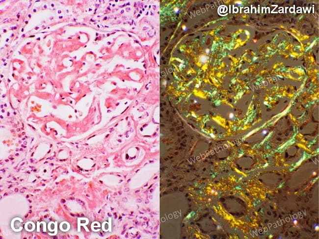 This renal cortical histology specimen demonstrates AL-type amyloidosis with kidney involvement in a patient with multiple myeloma. The left panel shows hematoxylin and eosin–stained tissue with amorphous, eosinophilic extracellular deposits within the glomerular mesangium and extending into the tubulointerstitium, causing mesangial expansion and variable basement membrane thickening. The right panel uses Congo Red staining to highlight the amyloid deposits, which appear salmon-pink on bright-field examination. Under polarized light, the same deposits display the diagnostic apple-green birefringence, a hallmark of Congo Red–positive amyloid. The deposits are diffuse, involving multiple glomeruli and extending into the tubulointerstitium, sometimes outlining capillary walls. In AL amyloidosis associated with plasma cell dyscrasia, the deposited light-chain–derived proteins disrupt normal renal architecture and contribute to proteinuria and progressive renal impairment. Differential considerations include AA (secondary) amyloidosis and other renal amyloidoses, but the combination of a known plasma cell disorder, Congo Red positivity, and apple-green birefringence strongly supports AL-type amyloidosis. This image serves as a valuable teaching reference for renal pathology, nephrology, and hematology-oncology, illustrating classic Congo Red histology, amyloid distribution patterns within glomeruli and interstitium, and the polarizing light signature. Correlates with proteinuria and renal dysfunction in many myeloma patients, guiding targeted therapy and monitoring of clonal plasma cell burden.