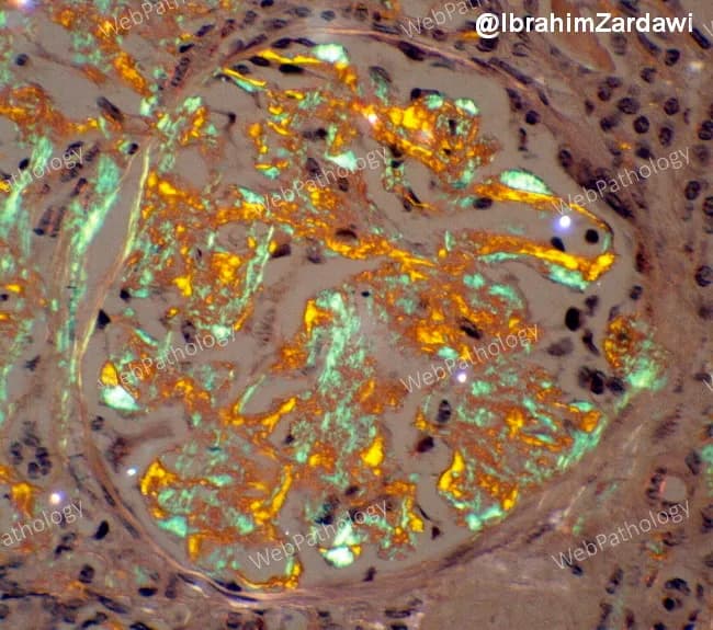 Renal biopsy histology of a patient with multiple myeloma showing AL-type amyloid deposition within the kidney. Congo red–stained sections reveal extracellular, eosinophilic, acellular deposits in the glomerular mesangium and throughout the tubulointerstitium; these deposits are salmon-pink on routine light microscopy. When viewed under polarized light, the Congo red positive material displays the diagnostic apple-green birefringence, confirming amyloid. The deposits disrupt normal glomerular architecture, with mesangial expansion, thickened capillary loops, and variable involvement of the tubules and interstitium; vascular involvement may be appreciated as deposition in arterioles. The lamina appears to be produced by a monoclonal immunoglobulin light chain (AL type) associated with underlying plasma cell dyscrasia; in the setting of myeloma, AL amyloidosis accounts for this pattern. Clinically, such renal amyloid deposition commonly correlates with nephrotic-range proteinuria, hypoalbuminemia, edema, and progressive renal insufficiency leading to chronic kidney disease if untreated. The image illustrates Congo red positivity and apple-green birefringence, the gold-standard histologic features used to diagnose systemic AL amyloidosis. Confirmatory typing by immunohistochemistry or mass spectrometry is often pursued. This histology is critical for prognosis and guides therapy targeting the plasma cell clone rather than only symptomatic management. This pattern supports systemic evaluation for underlying plasma cell dyscrasia.