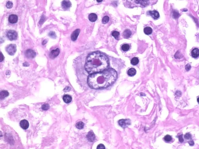 Histopathology: Light microscopy of an H&E-stained lymph node biopsy. This image highlights classic Reed-Sternberg (RS) cells within a mixed inflammatory background, a hallmark of classic Hodgkin lymphoma (cHL). The RS cells are large (up to ~100 microns) with abundant pale eosinophilic cytoplasm and prominent, bilobed to multinucleate nuclei. The nuclei show vesicular chromatin and thick nuclear membranes, with large central nucleoli creating an owl-eye appearance when two nuclei are juxtaposed. Variants, including giant RS cells and lacunar RS cells, may be seen in different HL subtypes. The surrounding milieu contains eosinophils, neutrophils, mature lymphocytes, plasma cells, and histiocytes, reflecting a characteristic reactive infiltrate. The nodal architecture is variably effaced, sometimes with formation of a rosette-like collar of T lymphocytes around RS cells. Immunophenotyping in practice typically demonstrates CD30 and CD15 positivity with weak PAX5 expression, supporting the HL diagnosis, and helps distinguish RS cells from RS-like cells in non-Hodgkin lymphomas or mimics such as anaplastic carcinoma. This histology provides essential diagnostic confirmatory evidence in suspected HL and informs prognosis and treatment planning (ABVD regimen, radiotherapy, or combined modality therapy). In some cases, classic RS cells may be absent, requiring ancillary testing and correlation with clinical findings, correlating with patient outcome.
