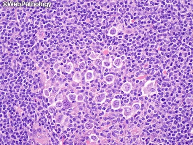 This histology image depicts lymph node tissue from a classic Hodgkin lymphoma with nodular sclerosis. The predominant cells are lacunar variants of Reed-Sternberg (RS) cells, characterized by multilobulated nuclei with coarse chromatin and small nucleoli, and a distinctive perinuclear cytoplasmic condensation that creates clear lacunar spaces in fixed tissues. The lacunae are artifacts of formalin fixation and are not present in B5-fixed specimens. Background comprises a mixed inflammatory milieu with small lymphocytes and scattered eosinophils embedded in fibrous nodules; the nodular architecture is evident with fibrous bands partitioning the lymph node into nodules, a hallmark of nodular sclerosis. RS cells may be solitary and scattered or form compact clusters and, in higher-grade nodular sclerosis (grade II), diffuse sheets. Clinical significance: The presence of lacunar RS cells in a fibrous nodal milieu supports a diagnosis of nodular sclerosis classic Hodgkin lymphoma. Differential considerations include other lymphadenopathies with RS-like cells (reactive conditions, other HL subtypes, or ALCL), but the combination of lacunar morphology, nodular sclerosis, and immunophenotype (CD30+, CD15+, PAX5 weak) is characteristic. This image is relevant for educational demonstrations of HL subtypes, fixation artifacts, and morphology-guided diagnosis, as well as educational references in pathology training and diagnostic review. Educational reference material.
