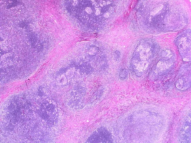 This light microscopic histopathology image depicts lymph node tissue stained with Hematoxylin and Eosin, examined at low magnification to emphasize nodular architecture characteristic of nodular sclerosis classical Hodgkin lymphoma. The sample reveals prominent nodularity with broad, concentric bands of hyalinized collagen that enclose discrete cellular nodules. Within these nodules, clusters of lacunar variant Reed-Sternberg cells are evident, accompanied by a sparsely cellular inflammatory background. The nodules display a mottled or moth-eaten appearance due to variable density of malignant RS cells and associated microabscesses or small foci of necrosis. The thick fibrous bands give the lymph node a fibrotic, polarized halo around nodules; in polarized light, the collagen may appear birefringent, highlighting the sclerosis. Overall the image demonstrates hallmarks of NSCHL: nodular sclerosis pattern, lacunar RS cells, and a desmoplastic stroma with dense collagen bands. Clinically, this pattern is associated with mediastinal involvement in younger patients and a favorable prognosis when treated appropriately. This histology is essential for differential diagnosis against other Hodgkin lymphoma subtypes (mixed cellularity, lymphocyte-rich) and against non-Hodgkin lymphomas. The image is relevant for pathology education, diagnostic pathology practice, and tumor biology research. Correlation with immunohistochemical profile and clinical staging enhances diagnostic confidence. Useful for teaching and research applications.