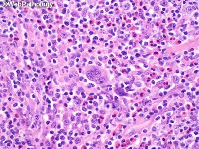 Imaging modality: bright-field light microscopy of a hematoxylin and eosin stained lymph node biopsy section viewed at high magnification. The tissue displays nodular sclerosis—nodules of lymphoid cells separated by thick bands of collagen—typical of classic Hodgkin lymphoma. The background comprises a mixed inflammatory infiltrate including eosinophils, neutrophils, small lymphocytes, plasma cells, and histiocytes. Fibroblasts are present within the fibrous bands and contribute to sclerosis. Notable features include multinucleated Reed–Sternberg cells, often with prominent nucleoli, located centrally in nodules; occasional lacunar variants may be seen in deeper sections. Eosinophilic and sometimes neutrophilic microabscesses are common in the nodular background and can obscure or mimic necrotizing granulomas at low magnification. The cellular composition varies between nodules, producing a heterogeneous appearance. This histology supports a diagnosis of nodular sclerosis type of classic Hodgkin lymphoma when combined with immunophenotypic data (CD15+, CD30+, PAX5 weak). Diagnostic significance lies in identifying RS cells within a reactive milieu; differential diagnoses include granulomatous inflammation and other lymphomas. Clinically, this pattern often correlates with mediastinal or peripheral lymphadenopathy in young adults and informs staging, prognosis, and chemotherapy decisions. In sum, lymphoid nodules with fibrous septa and RS cells characterize nodular sclerosis HL.