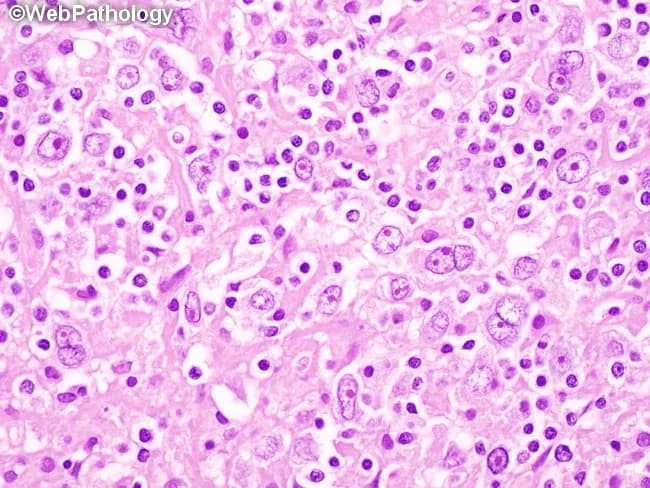 This histopathology image depicts a hematoxylin and eosin (H&E) stained lymph node biopsy section examined under bright-field light microscopy. The predominant nodular sclerosis pattern features fibrous bands dividing the paracortex into discrete nodules. Within the nodules, numerous Reed-Sternberg (RS) cells and Hodgkin cells are evident; RS cells frequently display binucleation with prominent eosinophilic nucleoli and an 'owl's eye' appearance. A lacunar variant of RS cells may be present, characterized by abundant pale cytoplasm and retraction artifacts in formalin-fixed tissue. Background inflammatory cells are relatively sparse but include small lymphocytes and occasional eosinophils; overall lymphoid architecture is disrupted by collagenous septa. The appearance is characteristic of classic Hodgkin lymphoma, nodular sclerosis subtype, which often presents with mediastinal or nodal involvement. Diagnostic significance lies in identifying RS/Hodgkin cells amid a fibrotic nodular framework, supporting a diagnosis of cHL and guiding therapy decisions. Clinically, this image is relevant for educational purposes, hematopathology training, differential diagnosis discussions with reactive lymphadenopathy, NLPHL distinctions, and confirmation of HL subtypes. Potential diagnoses to consider include nodular sclerosis cHL versus NLPHL, other B-cell lymphomas; immunophenotypic studies (CD30+, CD15+, PAX5 weak) and staging (PET-CT) commonly accompany histology for treatment planning.