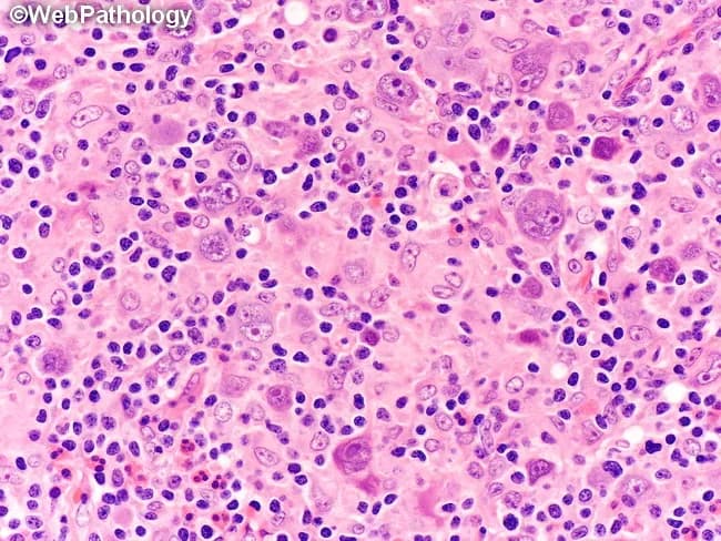 This histopathology image depicts recurrent nodular sclerosis classical Hodgkin lymphoma (cHL) on a hematoxylin and eosin stained lymph node biopsy. The tissue is examined under brightfield light microscopy at high-power fields; the nodular architecture is demonstrated by fibrous bands creating discrete nodules with collagenous sclerosis. Within the nodules, numerous classic Reed-Sternberg (RS) cells are present, frequently bi- or multinucleated with prominent eosinophilic nucleoli and ample cytoplasm; lacunar variants may be observed. The background shows a mixed inflammatory milieu including lymphocytes, plasma cells, neutrophils, eosinophils, and histiocytes; eosinophil-rich infiltrate is characteristic of cHL. Immunophenotype typical of RS cells is implied but not shown here: CD30 and CD15 positivity with PAX5 dim/weak positivity and variable CD20 negativity, helping distinguish cHL from other lymphoproliferative disorders. The sclerosis pattern and RS cell morphology, in the appropriate clinical context, support a relapse rather than a de novo lymphoma; however, post-therapy changes can alter cellular composition. This image underlines the importance of correlating histology with prior treatment history and immunohistochemistry to confirm relapse, guide staging, and inform therapy decisions, including salvage regimens or autologous stem cell transplantation considerations. Correlating morphology with immunophenotype and clinical history is essential for accurate relapse assessment. This informs prognosis and therapeutic strategy.