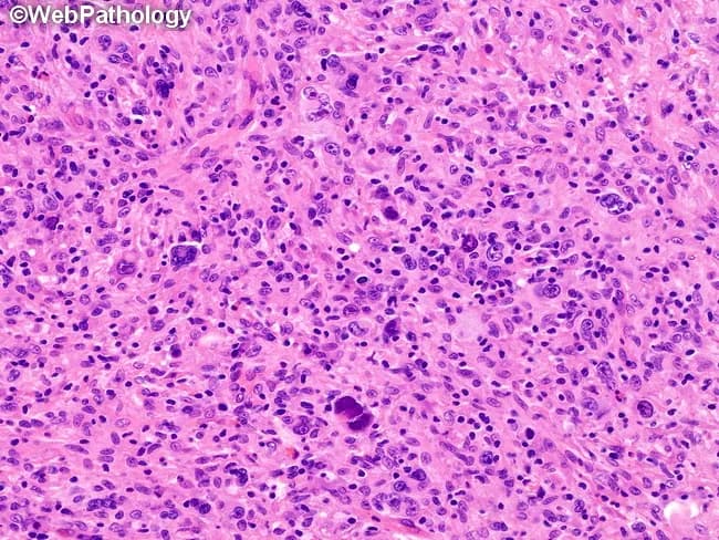 Histopathology image: Lymph node biopsy stained with Hematoxylin and Eosin (H&E) examined under light microscopy, high magnification. The sample displays lymphoreticular tissue composed of a dense inflammatory background with numerous small lymphocytes and occasional histiocytes. Scattered large atypical cells with prominent nucleoli are identifiable, consistent with Reed–Sternberg (RS) cells and their variants. In this Grade II presentation of nodular sclerosis classical Hodgkin lymphoma (cHL), numerous, bizarre, anaplastic RS cells are seen within a milieu that lacks substantial lymphocyte depletion. The architectural pattern may include nodularity interspersed by fibrous bands, a characteristic of nodular sclerosis, although the image emphasizes individual RS cells and a reactive infiltrate. The RS cells resemble owl-eye nucleoli within a large cytoplasm; immunophenotype typically CD30+, CD15+, CD20−/variable, PAX5 weak, EBV status variable. The observed features correspond to a higher-grade cHL subset, yet grading is primarily a research construct and not essential for routine clinical management. Clinically, this histology correlates with aggressive behavior in some nodal HL cases but usually responds to standard chemotherapy regimens. The image is useful for education about HL morphology, RS cell pleomorphism, differential diagnosis (anaplastic large cell lymphoma, NLPHL, reactive lymphoid hyperplasia) and research correlations in HL grading strategies.