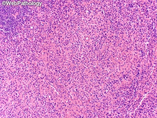 This brightfield histopathology image depicts a lymph node biopsy illustrating a histiocyte-rich variant of mixed cellularity classical Hodgkin lymphoma. The tissue is sectioned and stained with hematoxylin and eosin, viewed at low-to-intermediate magnification, revealing a densely cellular background with a prominent infiltrate of histiocytes and epithelioid macrophages forming aggregates, accompanied by scattered eosinophils, lymphocytes, plasma cells, and occasional neutrophils. The classic Reed-Sternberg cells are present but may be sparse within the abundant histiocytic milieu, with multilobed nuclei and prominent nucleoli. The architectural pattern is polymorphic rather than nodular, lacking prominent fibrous bands characteristic of nodular sclerosis. The histiocyte-rich variant features abundant macrophages mirroring granulomatous-like features, potentially mimicking inflammatory conditions; however, residual neoplastic Hodgkin cells in this setting bear the typical immunophenotype (CD30+, CD15+, PAX5 weak) in adjacent areas. Clinically, this histology correlates with mixed cellularity Hodgkin lymphoma, a B-cell origin neoplasm presenting with constitutional symptoms and lymphadenopathy. The image is relevant for educational demonstration of HL subtypes, differential diagnoses with non-Hodgkin lymphomas and granulomatous processes, and for training in histopathologic recognition, pattern recognition, and morphologic correlation with immunophenotype and clinical findings. Immunohistochemistry supports diagnosis by highlighting Reed-Sternberg cells (CD30+, CD15+, PAX5 weak) amid a histiocyte-rich background; EBV association may be variable; clinical staging and treatment follow Hodgkin lymphoma guidelines.