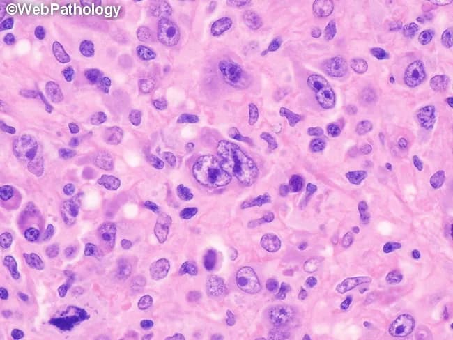 This histopathology image depicts a lymph node biopsy showing features diagnostic of lymphocyte-depleted classic Hodgkin lymphoma, reticular subtype. Using light microscopy on an H&E-stained paraffin section, the lymphoid architecture is markedly effaced by a cellular sheet of large, atypical mononuclear cells with prominent nucleoli. Occasional Reed-Sternberg cells are visible within the expansive background, including cells with multilobed or bilobed nuclei and prominent eosinophilic nucleoli, characteristic of Hodgkin lymphoma. The RS cells are scattered among numerous atypical mononuclear variants rather than forming a cohesive nodular structure. There is little-to-no fibrosis and only sparse non-neoplastic inflammatory cells, which is typical for the lymphocyte-depleted pattern. The background may show rimming by small lymphocytes and histiocytes in a reticular network, but overall cellularity is high. Immunophenotypic markers are not shown here, but in clinical practice RS cells typically express CD30 and CD15 with weaker PAX5 or B-cell markers. The diagnostic significance lies in recognizing the lymphocyte-depleted cHL morphology, which carries distinct clinical implications, often presenting with advanced stage disease and systemic symptoms. This image is useful for educational purposes, differential diagnosis conversation, and correlating histology with treatment planning (ABVD/BEACOPP regimens). Correlation with immunohistochemistry (CD30, CD15, PAX5) and EBV status further supports diagnosis in practice.