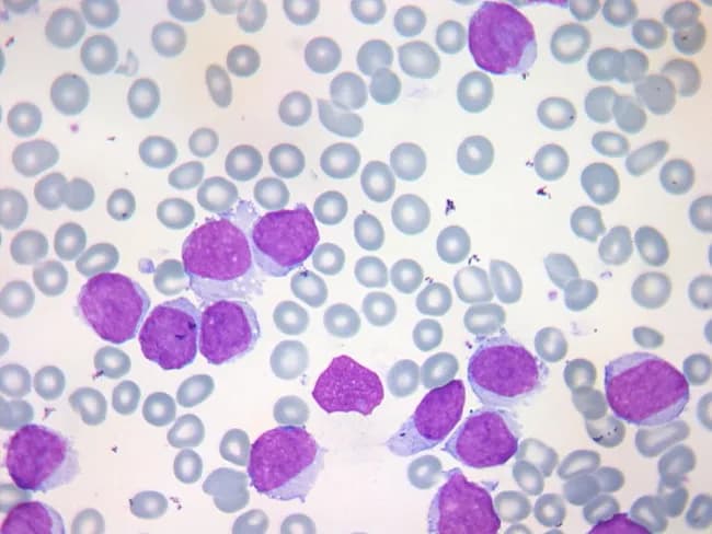 This is a light-m microscopy image of a peripheral blood smear, prepared with May-Grünwald-Giemsa stain and evaluated under standard hematology practice. The specimen demonstrates circulating malignant lymphoid cells consistent with mantle cell lymphoma in the leukemic phase. In typical MCL with blood involvement, the circulating cells are small to medium in size with scant cytoplasm and irregular, indented or clefted nuclei, and reticular chromatin; spectrums of blasts may occur in occasional cases. Notably, the clumped chromatin characteristic of chronic lymphocytic leukemia is not observed. In this slide, a subpopulation of larger cells with higher nuclear-to-cytoplasmic ratio and more conspicuous nucleoli resembles a blastoid morphology, correlating with the aggressive variant and rapid clinical progression (often 3–4 months). The background contains numerous mature erythrocytes and scattered neutrophils, providing a typical smear context. Immunophenotyping by flow cytometry would typically reveal clonal B cells expressing CD5, CD19, CD20, surface immunoglobulin light chain restriction, and cyclin D1 overexpression due to t(11;14)(q13;q32). The presence of circulating tumor cells in peripheral blood can accompany massive splenomegaly with minimal nodal disease and has prognostic significance as a marker of disease burden. This image is educational for hematology, cytology, and pathology training, illustrating differential considerations among leukemic lymphoproliferations and guiding ancillary testing.