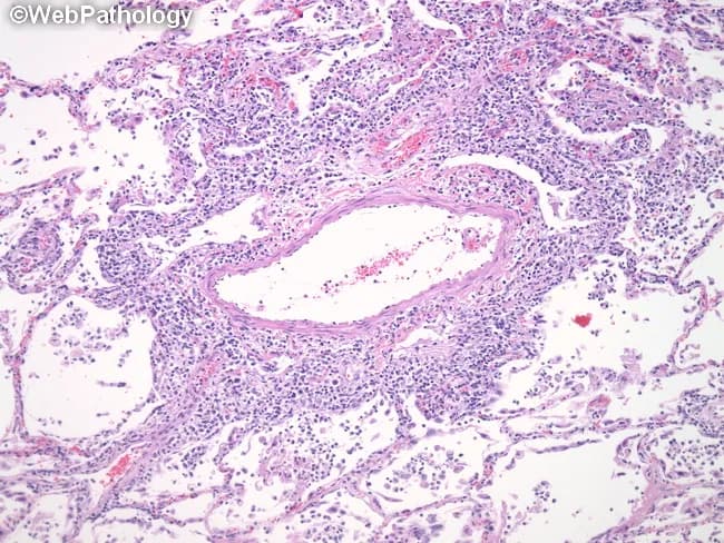 Imaging modality and technique: light microscopy of a formalin-fixed, paraffin-embedded lung biopsy stained with Hematoxylin and Eosin (H&E). The panel reveals an angiocentric lymphoid infiltrate surrounding a small blood vessel within lung parenchyma. The infiltrate is composed predominantly of small lymphocytes with scant cytoplasm and dark, round to slightly irregular nuclei, consistent with T-cell lineage; rare accompanying histiocytes may be present. Perivascular cuffs encroach on the vascular wall and create an unmistakable angiocentric pattern that is characteristic of lymphomatoid granulomatosis (LG). Overall lung architecture in the field is variably preserved, with focal interstitial inflammatory changes near vessels. In LG the lesion often contains endothelial damage and can progress to necrotizing vasculitis and, with time, clonal B-cell proliferation that is frequently EBV-associated; this exact panel does not provide EBV status. Clinically, LG presents with pulmonary symptoms such as cough, dyspnea, occasional chest pain, and may be accompanied by systemic symptoms like fever and weight loss. The cited histology is pivotal for differential diagnosis against granulomatosis with polyangiitis and infectious vasculitides. This image serves as an educational exemplar for pulmonary pathology, hematopathology, and EBV-associated lymphoproliferative disorders, illustrating the critical angiocentric, T-cell–predominant pattern. Correlation with imaging studies and clinical data is essential for accurate diagnosis and management.