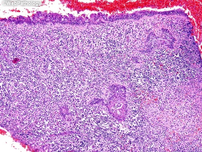 Histopathology of a nasal cavity biopsy stained with Hematoxylin and Eosin (H&E) highlighting extranodal NK/T‑cell lymphoma, nasal type. The lesion shows a diffuse infiltrate of small to medium‑sized to occasionally large atypical lymphoid cells with irregular nuclei, conspicuous nucleoli, and frequent apoptotic bodies. Malignant cells are intensely angiocentric and angioinvasive, surrounding and destroying small blood vessels with resultant ischemic necrosis and focal ulceration of the overlying respiratory mucosa. The tumor is embedded in a dense inflammatory background rich in lymphocytes, plasma cells, histiocytes, and eosinophils. Overlying mucosa demonstrates squamous metaplasia and, in some fields, pseudoepitheliomatous hyperplasia that can mimic squamous cell carcinoma at limited magnification. Immunophenotype is typically CD56 positive with cytotoxic granule markers (granzyme B, TIA‑1) and an EBV association, often demonstrated by EBV-encoded RNA in situ hybridization. Clinically this histology corresponds to an aggressive sinonasal lymphoma requiring systemic therapy rather than local excision. The diagnostic significance rests on the characteristic angioinvasion/angiocentric growth and EBV linkage, which distinguish it from reactive processes and many other nasal neoplasms. Educationally, this image supports recognition of pattern, differential diagnosis, and correlations with clinical presentation, prognosis, and treatment planning. This educational resource aids pathologists, clinicians, and students in accurate classification and differential diagnosis.