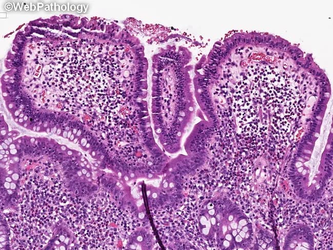 This histopathology image depicts small intestinal mucosa with celiac disease-type changes in tissue adjacent to Enteropathy-associated T-cell lymphoma (EATL). Acquired by light microscopy from a mucosal biopsy of the jejunum/ileum, the slide shows pronounced villous blunting with crypt hyperplasia, producing a columnar, shortened villi profile. The surface epithelium reveals increased intraepithelial lymphocytes arranged along the villous axis; lamina propria is chronically inflamed with lymphocytes and plasma cells. These features are classic for gluten-sensitive enteropathy and can precede or accompany overt lymphomatous transformation in EATL. The mucosal architecture is distorted, with a spectrum from mild to severe villous atrophy; goblet cells are reduced; enterocytes may display reactive changes. The image captures the inflammatory milieu and barrier dysfunction characteristic of celiac disease, reflecting malabsorption risk and nutritional compromise. In the context of suspected or known EATL, this histology underscores the background gluten-inducible enteropathy that predisposes to malignant T-cell transformation. Clinically, such specimens guide diagnosis, prognosis, and therapeutic planning, including dietary gluten exclusion and surveillance for lymphoma. This histologic pattern should be correlated with serology, imaging, and molecular studies to differentiate celiac disease from refractory celiac disease and to assess lymphoma risk. Additionally, this pattern has educational utility.