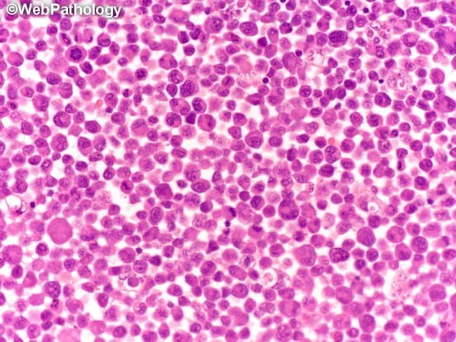This brightfield light microscopy image depicts a dense bone marrow aspirate smear stained with hematoxylin and eosin. The cellularity is high with a uniform population of small to medium-sized lymphoid cells (lymphoblast-like cells) occupying much of the field. Nuclei are round to ovoid with finely dispersed, coarse chromatin, and scant basophilic cytoplasm; nucleoli are inconspicuous. The architecture is diffuse rather than follicular, with little evidence of erythroid or myeloid precursors; occasional mitotic figures may be present but are not prominent at this magnification. The histology shows a monotonous lymphoid infiltrate, a pattern that raises concern for a lymphoblastic process. Pathologic interpretation would emphasize lymphoid blasts consistent with acute lymphoblastic leukemia or lymphoblastic lymphoma; however, definitive classification requires ancillary studies such as flow cytometry immunophenotyping, immunohistochemistry, and genetic studies (cytogenetics/molecular). Clinically, such a pattern correlates with acute presentations: cytopenias, signs of marrow failure, fatigue, infections, or organomegaly. Potential uses include medical education for recognizing quantitative lymphoid blasts on bone marrow smears, training in differential diagnoses of monomorphic blue cell infiltrates, and optimizing search queries for pathology image datasets. Keywords include: lymphoblasts, pediatric ALL, bone marrow failure, marrow infiltration, hematopathology, immunophenotype, CD markers, prognosis guidance, diagnostic workflow, and educational value overall.